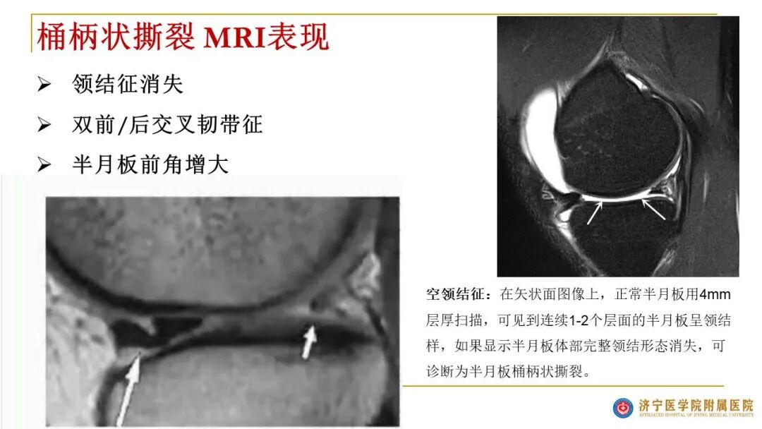 【图文并茂】膝关节MRI解剖及常见病诊断