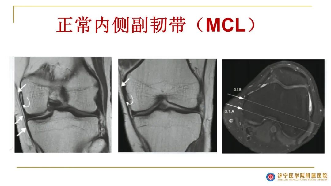 【图文并茂】膝关节MRI解剖及常见病诊断