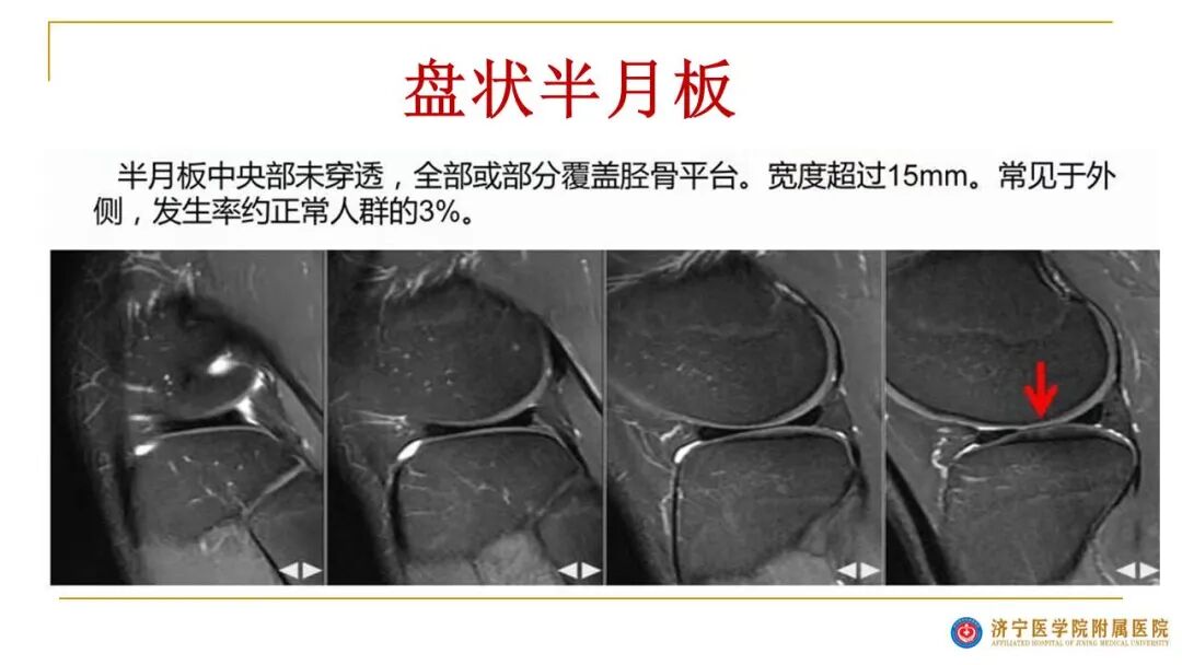 【图文并茂】膝关节MRI解剖及常见病诊断