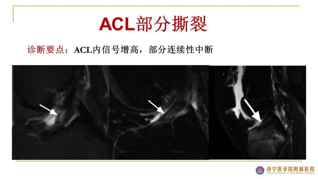 【图文并茂】膝关节MRI解剖及常见病诊断