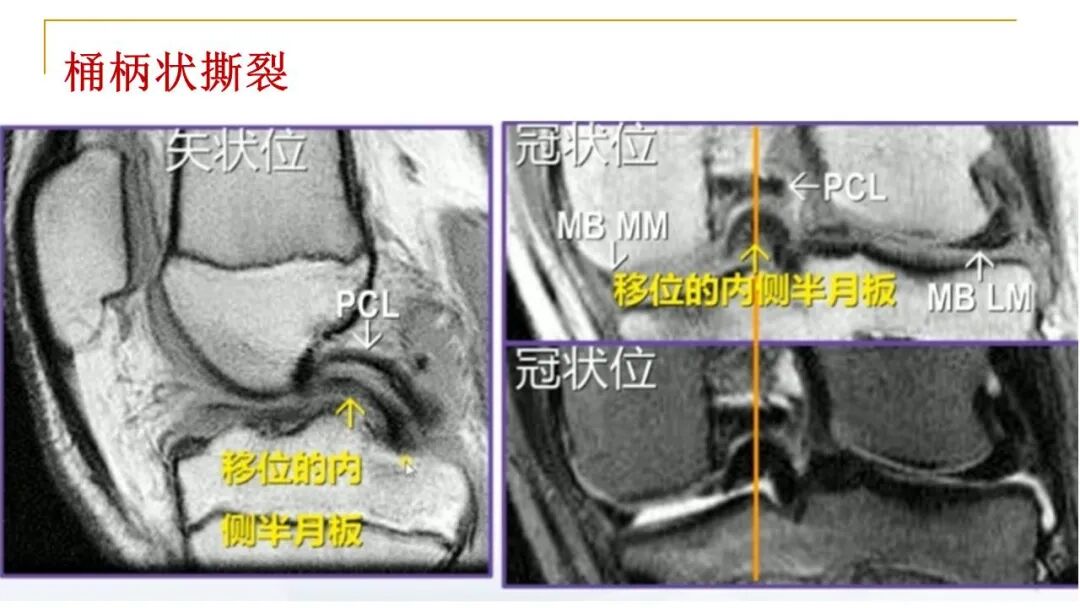 【图文并茂】膝关节MRI解剖及常见病诊断
