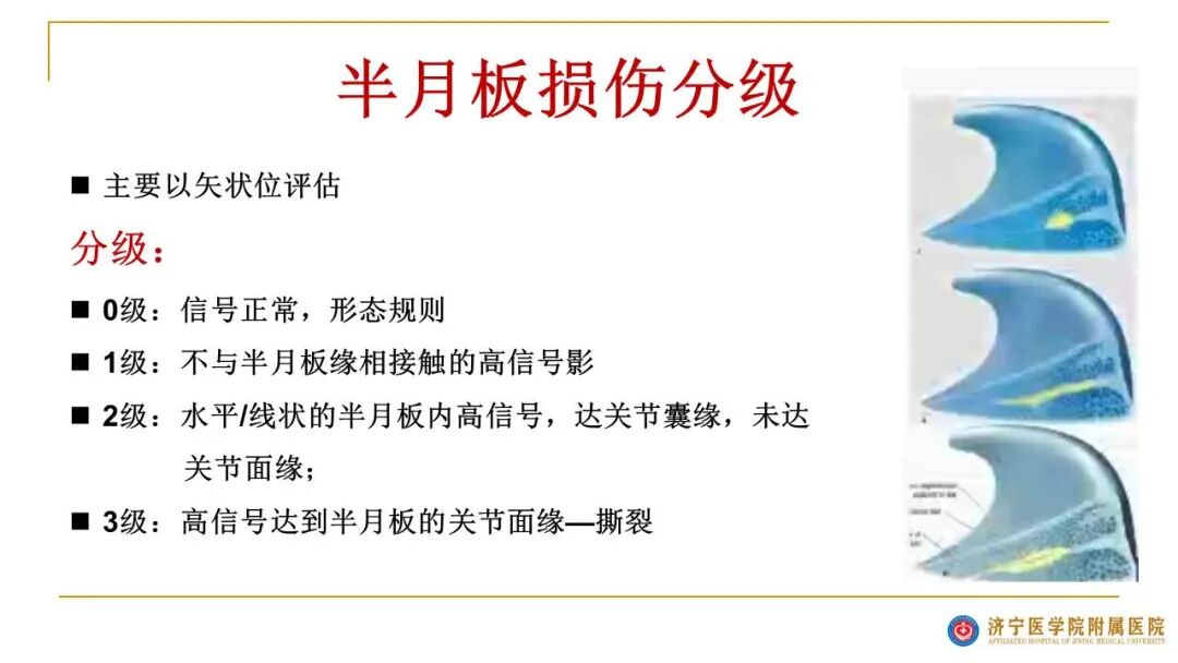 【图文并茂】膝关节MRI解剖及常见病诊断