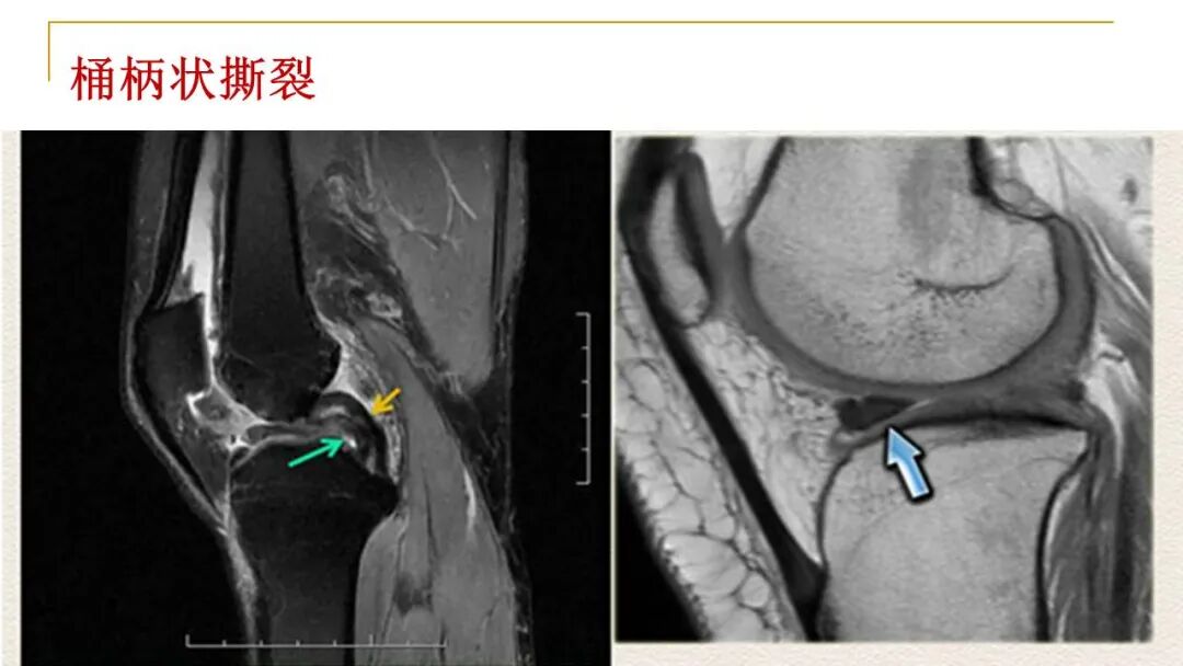 【图文并茂】膝关节MRI解剖及常见病诊断