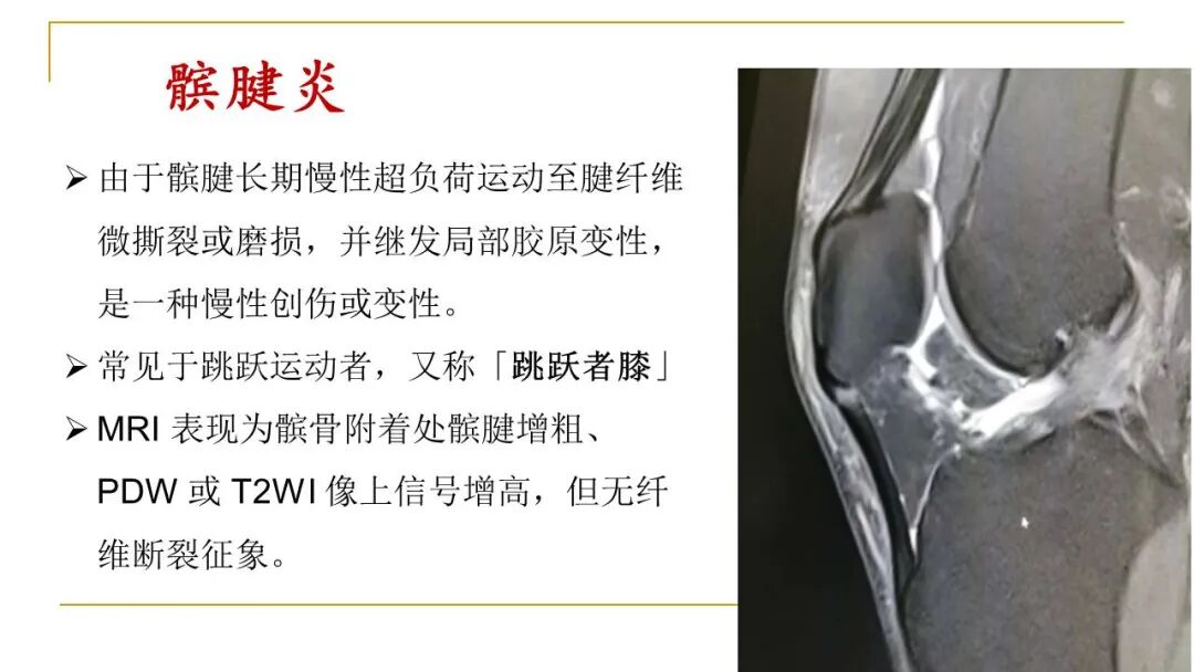 【图文并茂】膝关节MRI解剖及常见病诊断