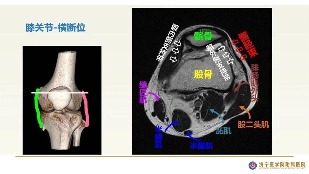 【图文并茂】膝关节MRI解剖及常见病诊断