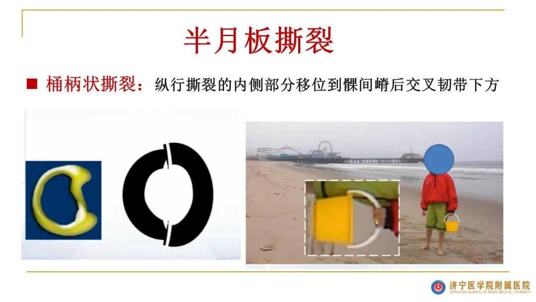 【图文并茂】膝关节MRI解剖及常见病诊断