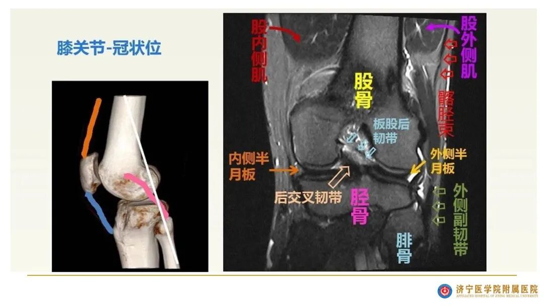【图文并茂】膝关节MRI解剖及常见病诊断
