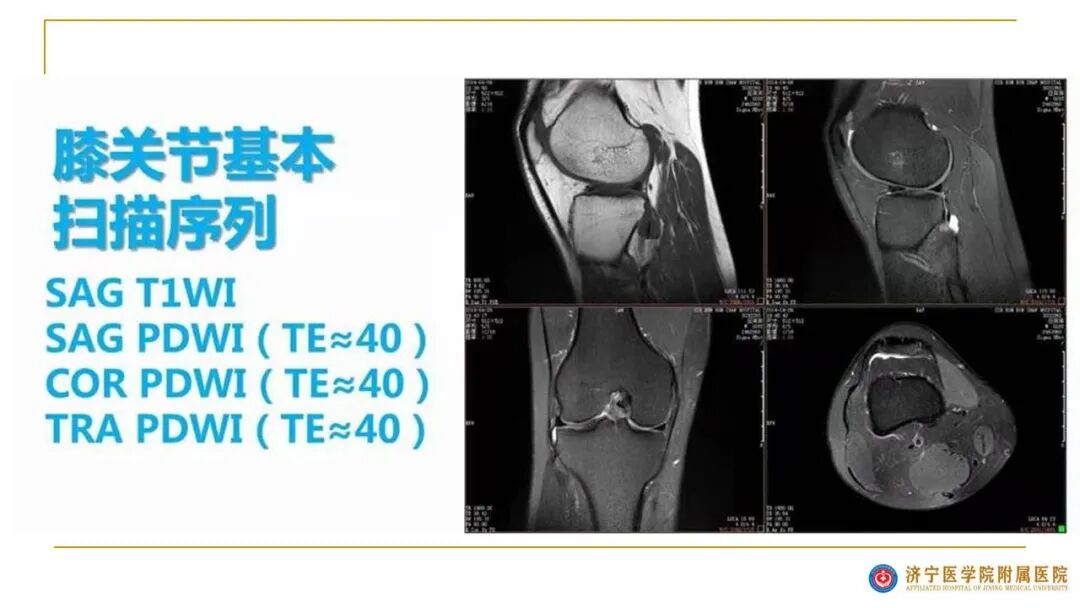 【图文并茂】膝关节MRI解剖及常见病诊断