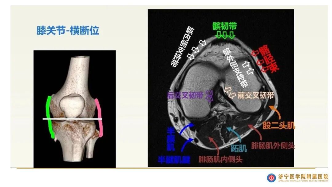 【图文并茂】膝关节MRI解剖及常见病诊断