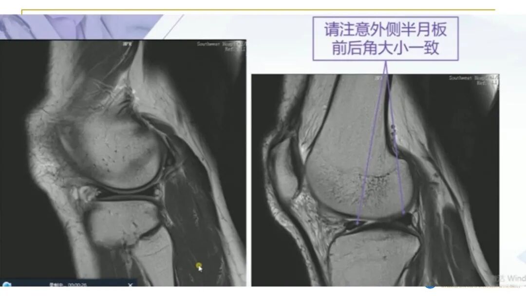 【图文并茂】膝关节MRI解剖及常见病诊断