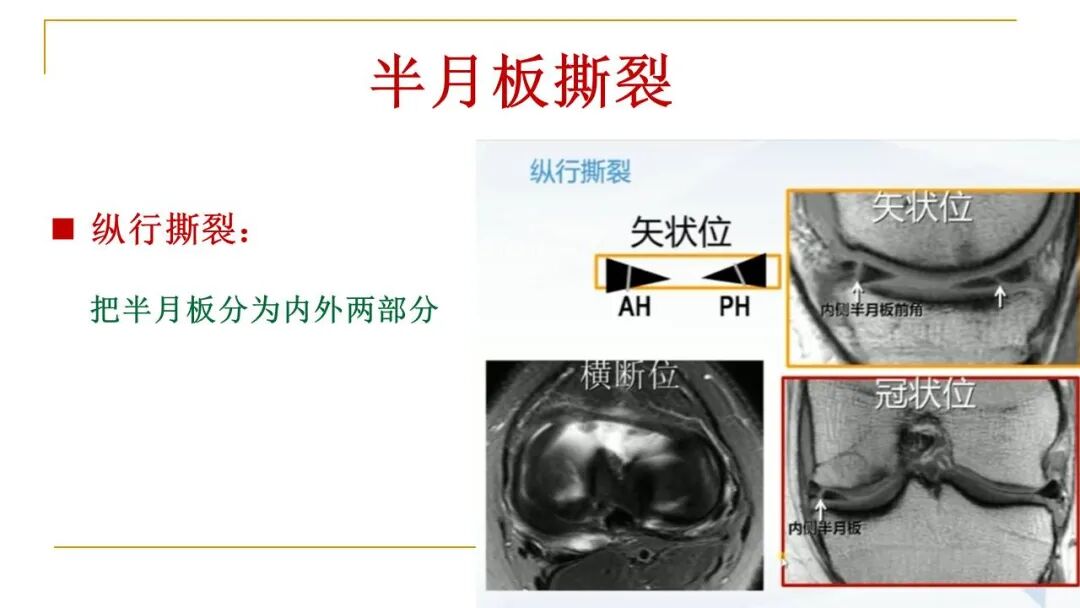 【图文并茂】膝关节MRI解剖及常见病诊断