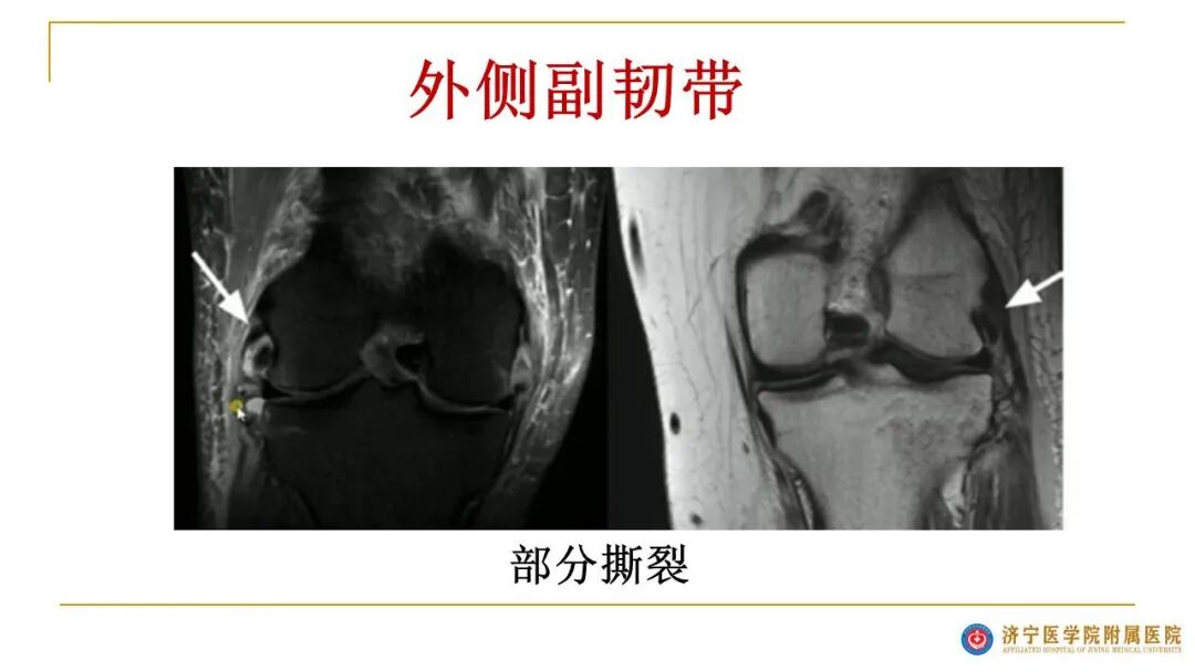 【图文并茂】膝关节MRI解剖及常见病诊断