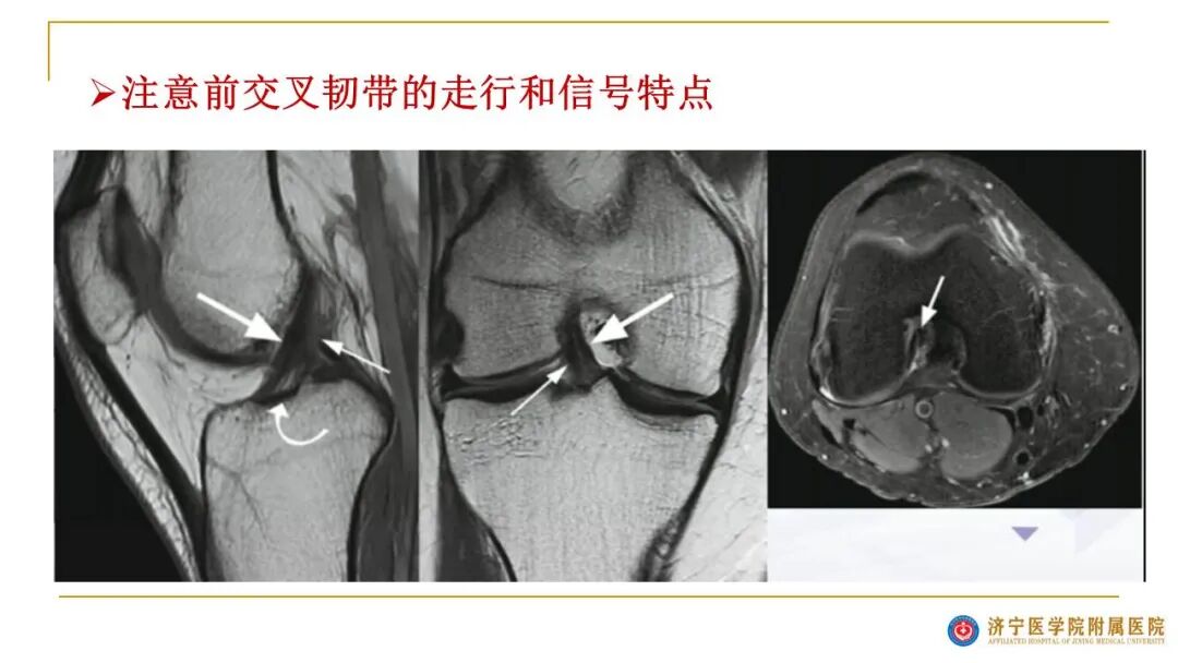 【图文并茂】膝关节MRI解剖及常见病诊断
