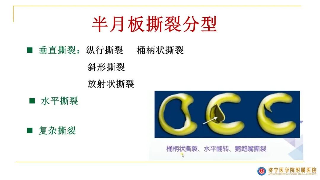 【图文并茂】膝关节MRI解剖及常见病诊断