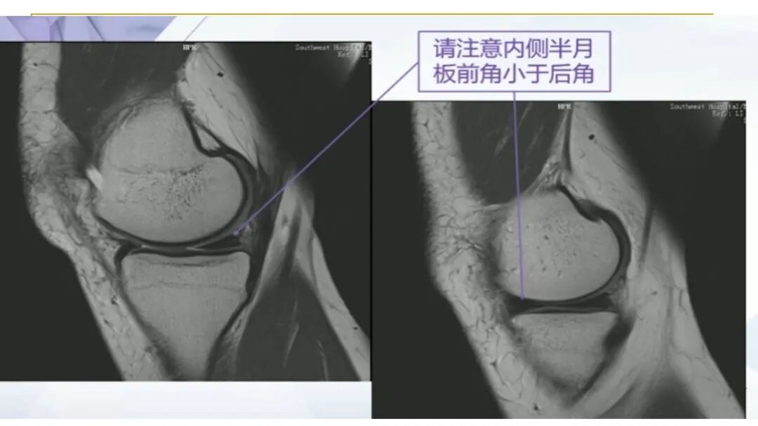 【图文并茂】膝关节MRI解剖及常见病诊断