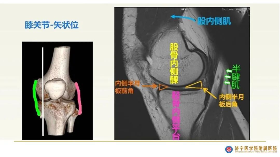 【图文并茂】膝关节MRI解剖及常见病诊断