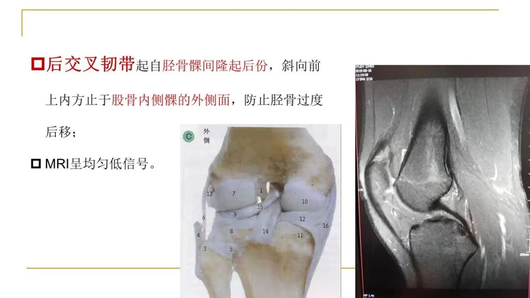 【图文并茂】膝关节MRI解剖及常见病诊断