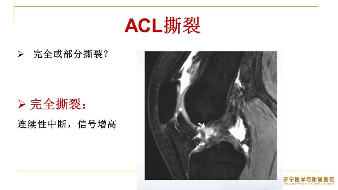 【图文并茂】膝关节MRI解剖及常见病诊断