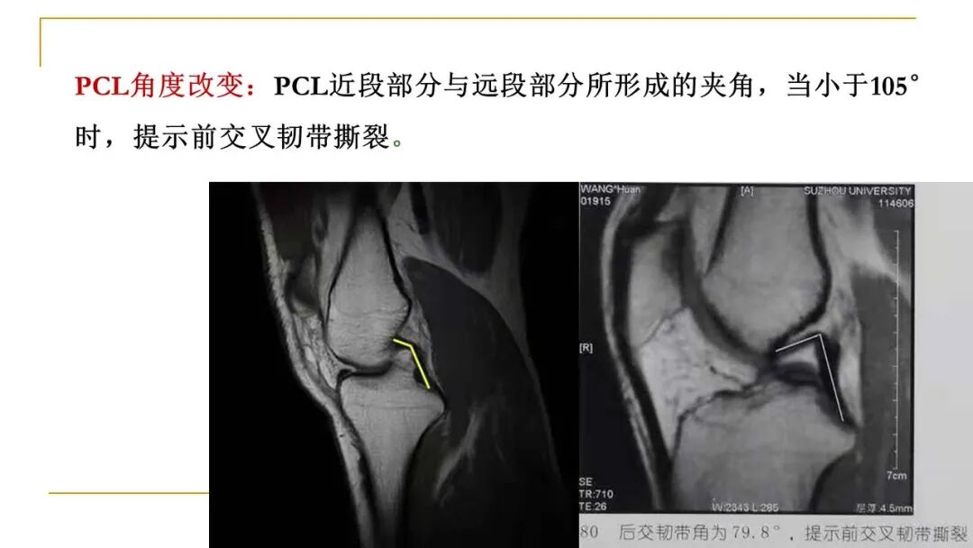 【图文并茂】膝关节MRI解剖及常见病诊断