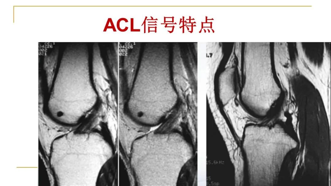 【图文并茂】膝关节MRI解剖及常见病诊断