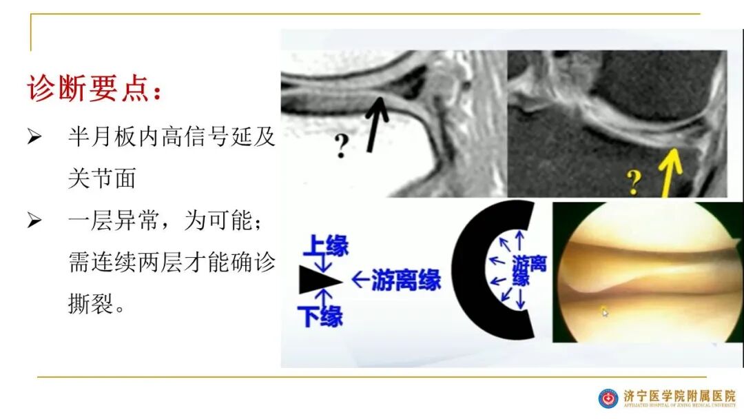 【图文并茂】膝关节MRI解剖及常见病诊断