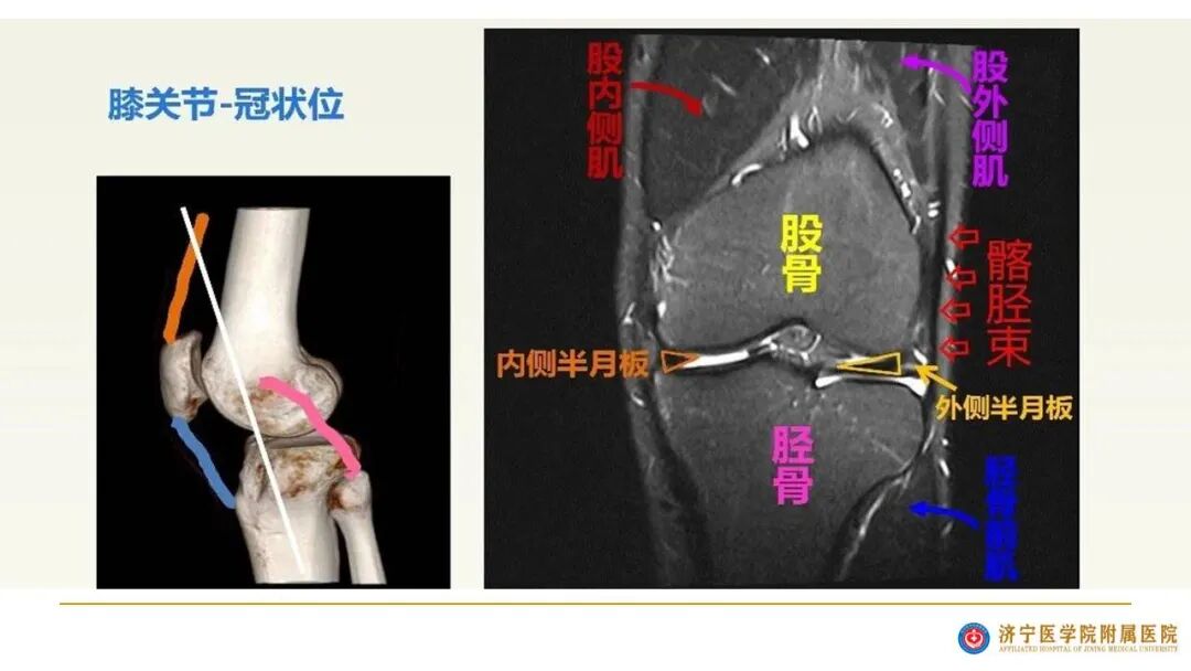 【图文并茂】膝关节MRI解剖及常见病诊断