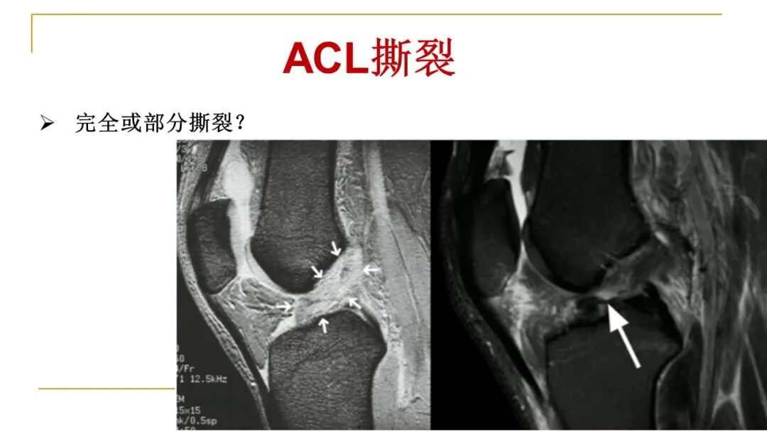 【图文并茂】膝关节MRI解剖及常见病诊断