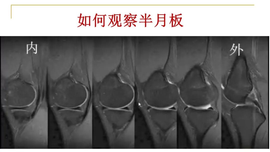 【图文并茂】膝关节MRI解剖及常见病诊断