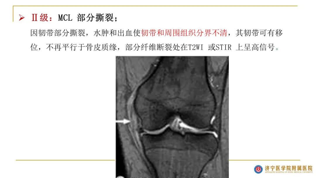 【图文并茂】膝关节MRI解剖及常见病诊断