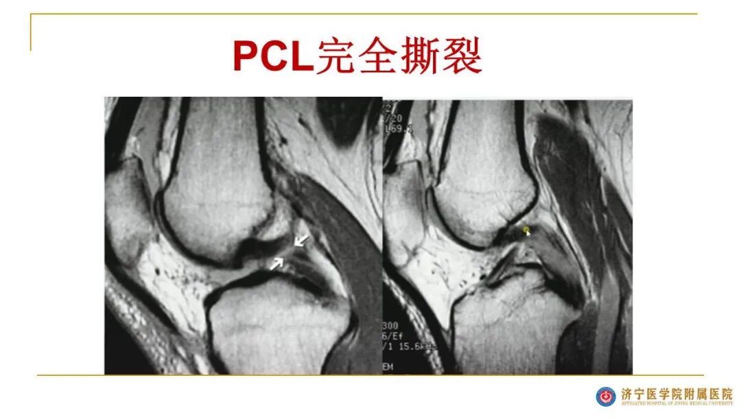 【图文并茂】膝关节MRI解剖及常见病诊断