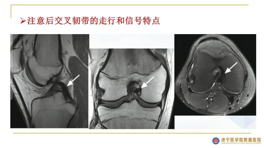 【图文并茂】膝关节MRI解剖及常见病诊断