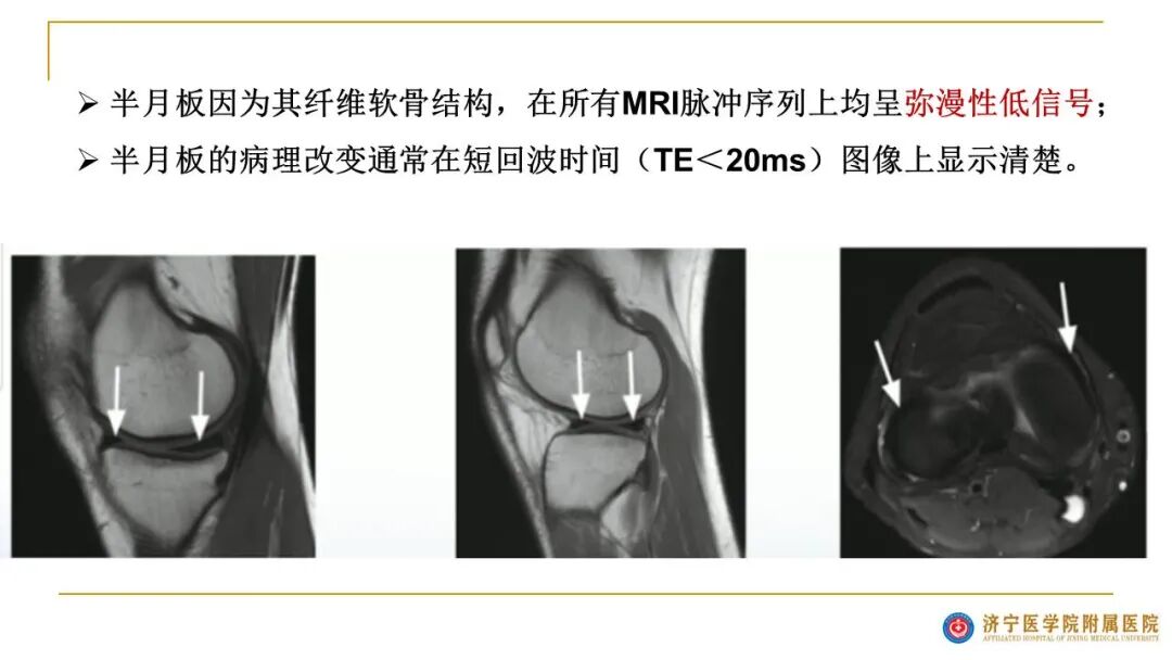 【图文并茂】膝关节MRI解剖及常见病诊断