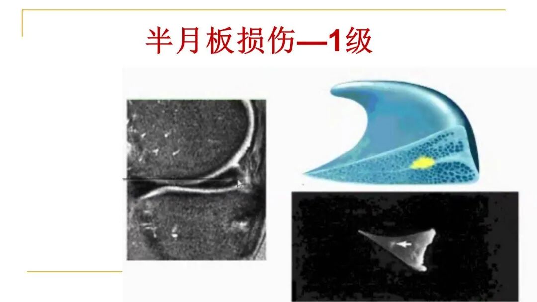 【图文并茂】膝关节MRI解剖及常见病诊断