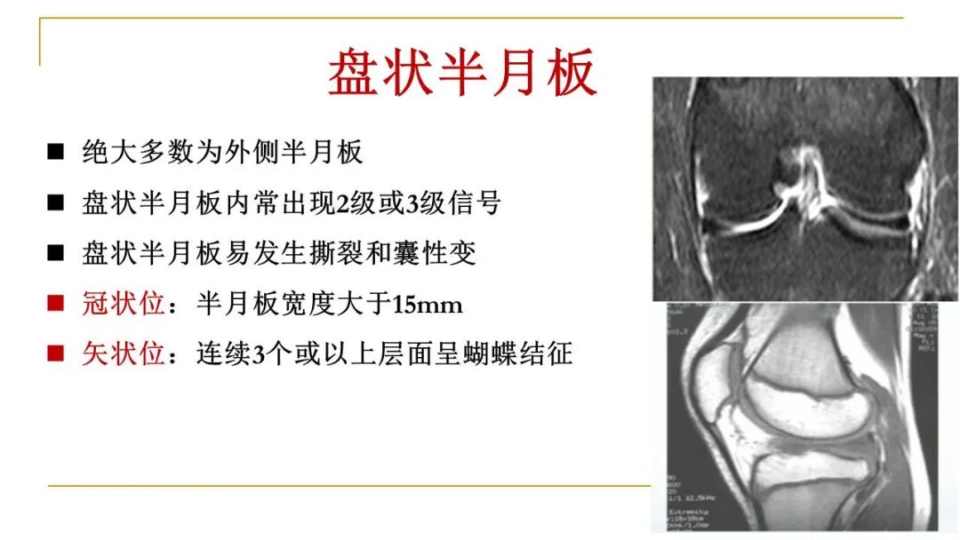 【图文并茂】膝关节MRI解剖及常见病诊断