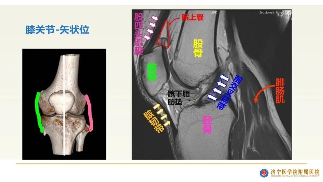 【图文并茂】膝关节MRI解剖及常见病诊断