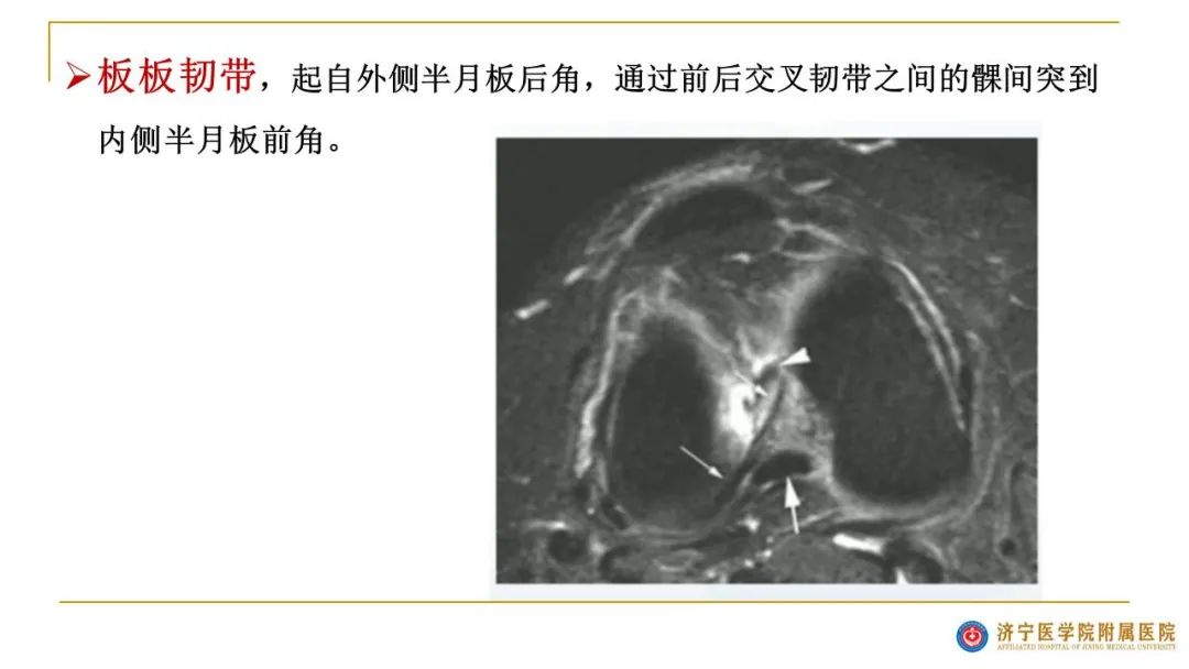 【图文并茂】膝关节MRI解剖及常见病诊断