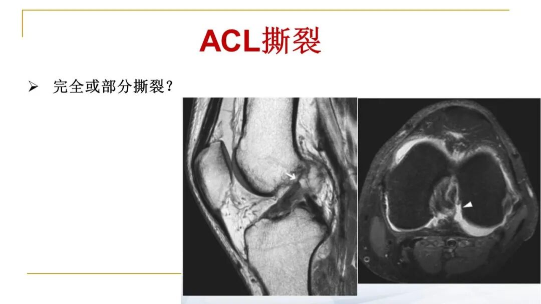 【图文并茂】膝关节MRI解剖及常见病诊断