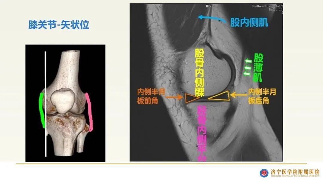【图文并茂】膝关节MRI解剖及常见病诊断