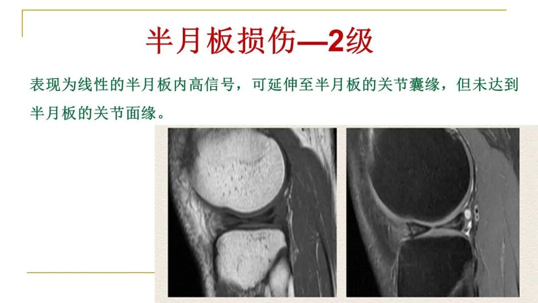 【图文并茂】膝关节MRI解剖及常见病诊断