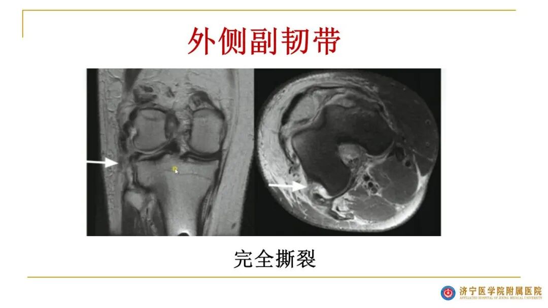 【图文并茂】膝关节MRI解剖及常见病诊断
