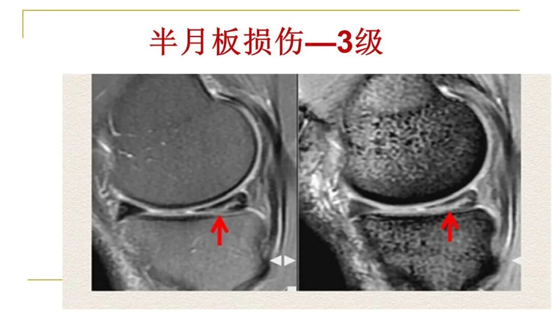 【图文并茂】膝关节MRI解剖及常见病诊断