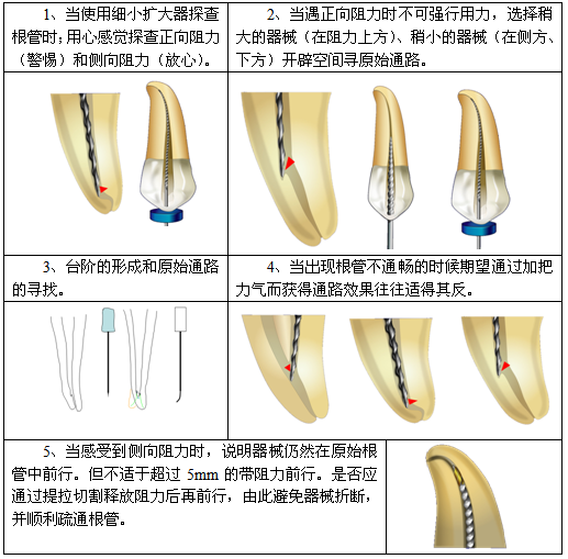 根管治疗的标准步骤，以及细节把握（长文收藏）