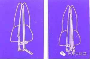 根管治疗的标准步骤，以及细节把握（长文收藏）