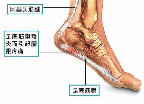 骨科医生诊疗宝典：足跟痛最全诊断与治疗方法汇总！