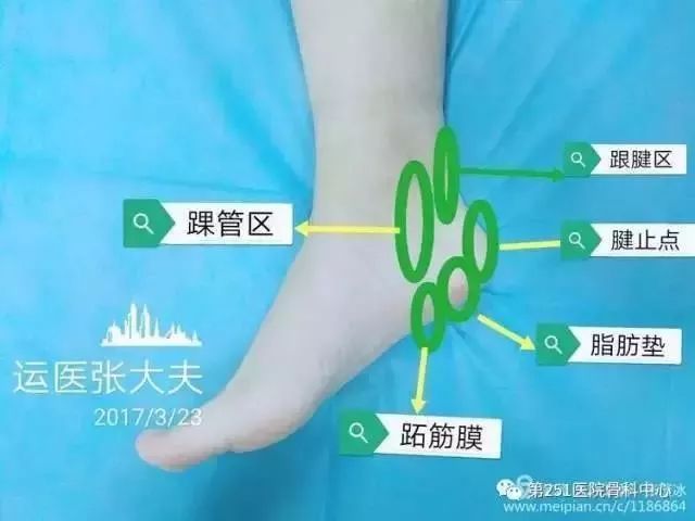 骨科医生诊疗宝典：足跟痛最全诊断与治疗方法汇总！