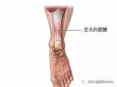 骨科医生诊疗宝典：足跟痛最全诊断与治疗方法汇总！