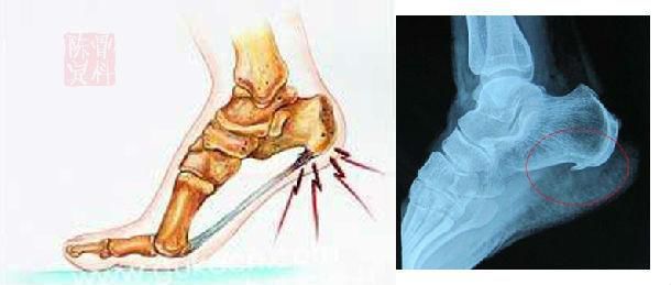 骨科医生诊疗宝典：足跟痛最全诊断与治疗方法汇总！
