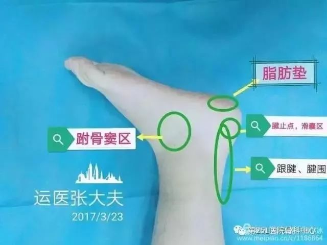 骨科医生诊疗宝典：足跟痛最全诊断与治疗方法汇总！