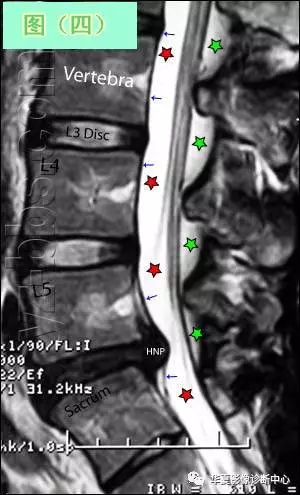 腰椎间盘突出症的CT及MRI读片技巧，基础必备！