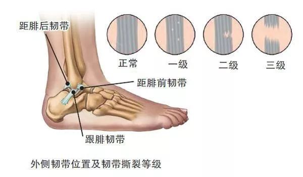 必须收藏：急性外侧踝关节扭伤最新指南解读！